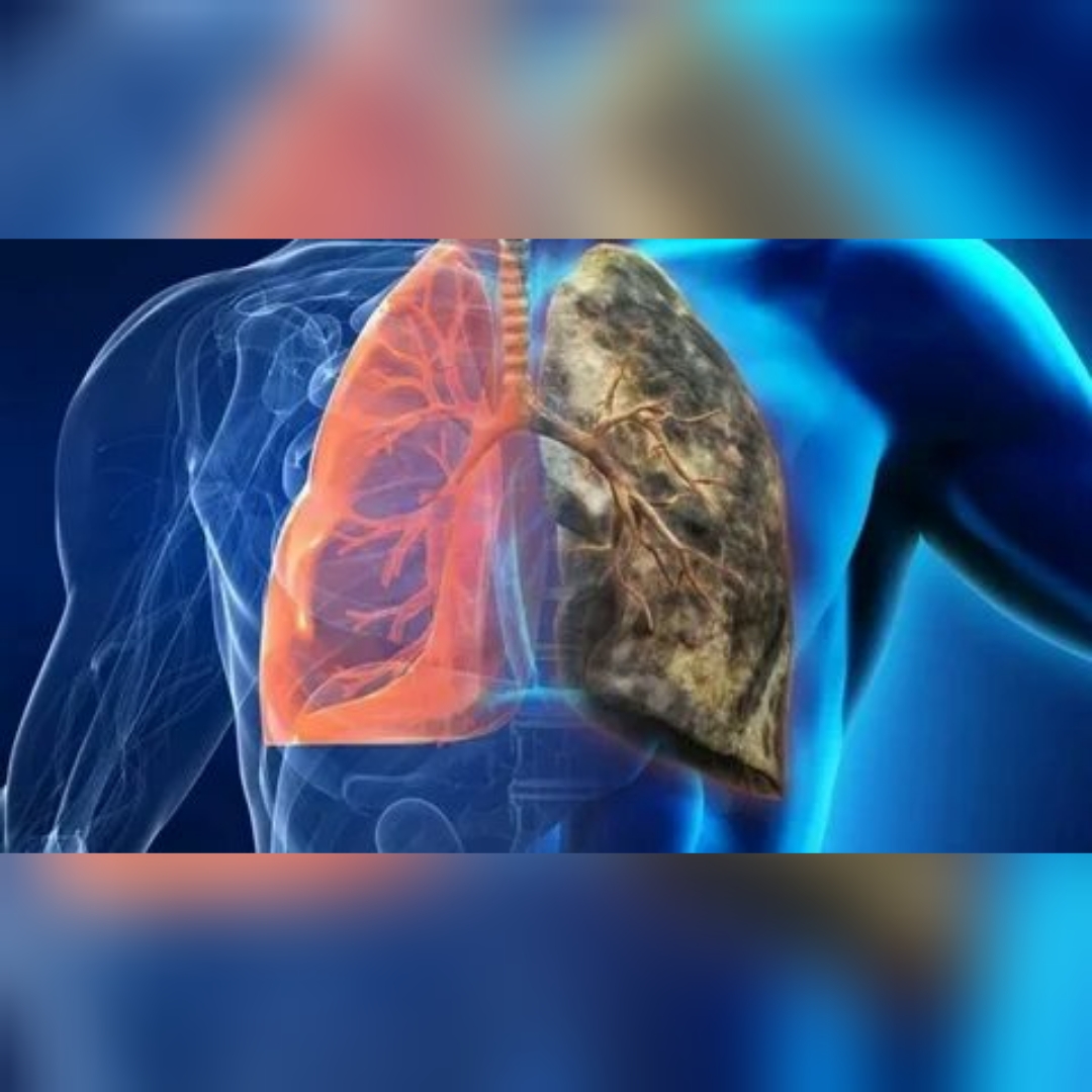 Неделя профилактики рака лёгких Неделя профилактики рака лёгких