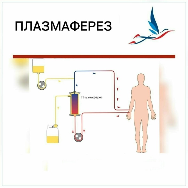 Плазмаферез в ОККД