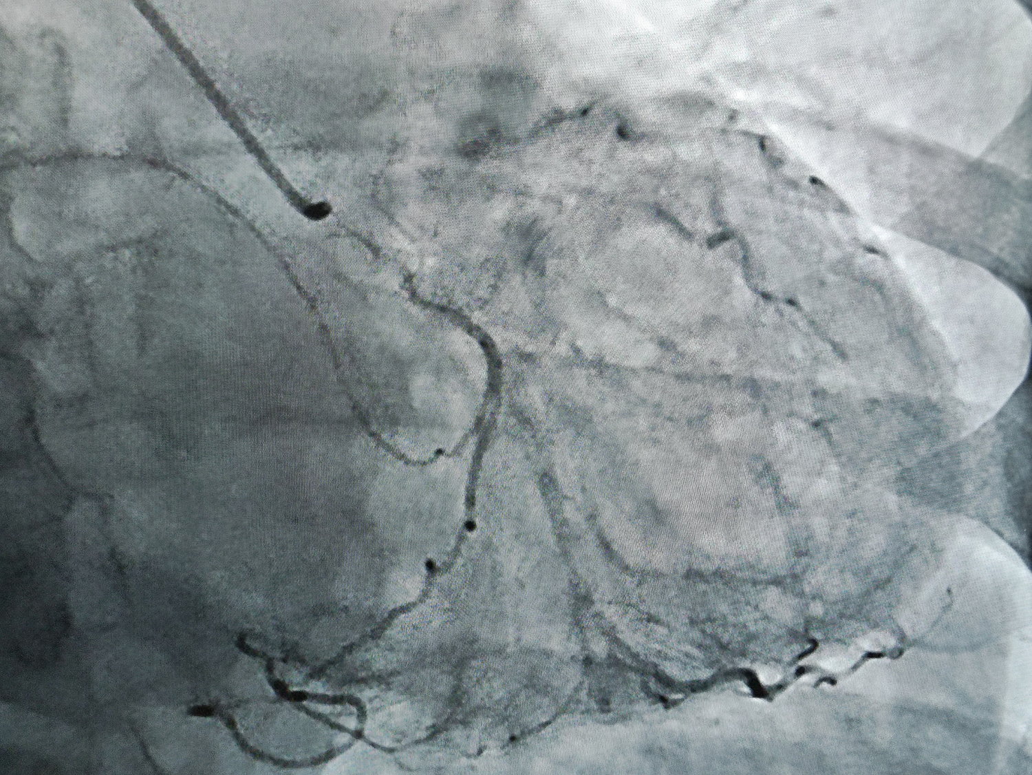 На новом ангиографе в Областном клиническом кардиодиспансере провели первые вмешательства